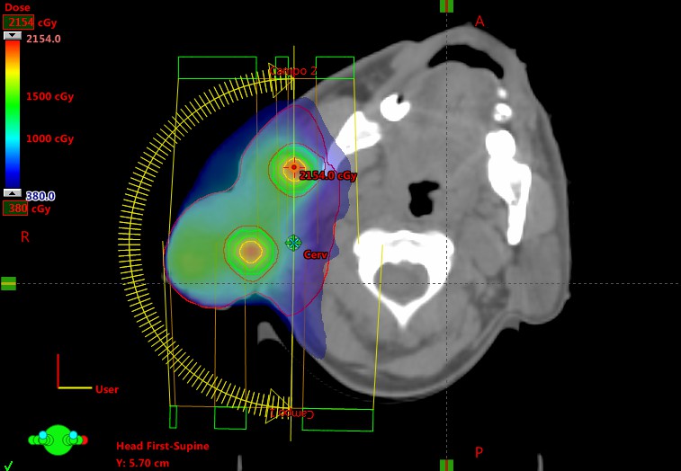 Imagem de planejamento da radioterapia lattice